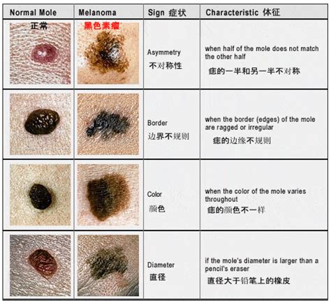 眼窩有痣